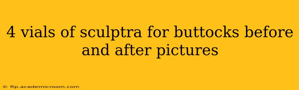 4 vials of sculptra for buttocks before and after pictures