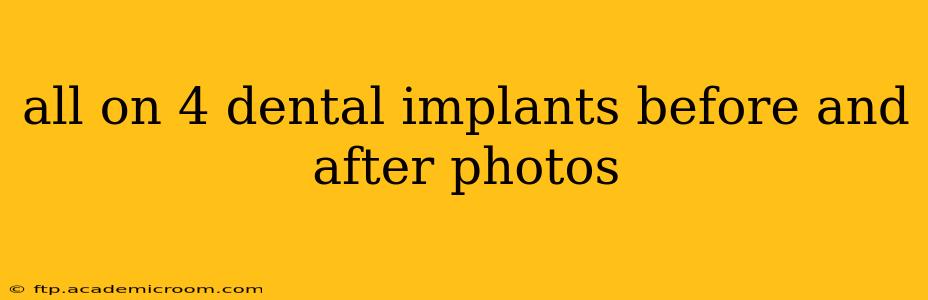 all on 4 dental implants before and after photos