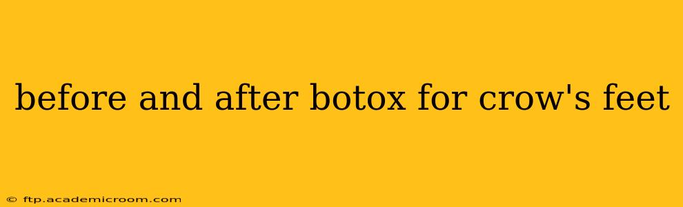 before and after botox for crow's feet