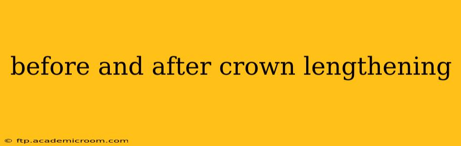 before and after crown lengthening