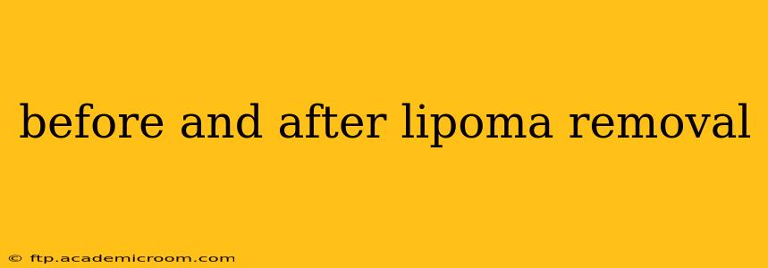 before and after lipoma removal