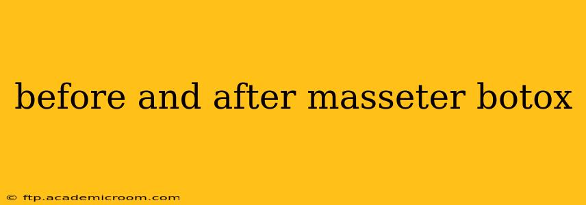 before and after masseter botox