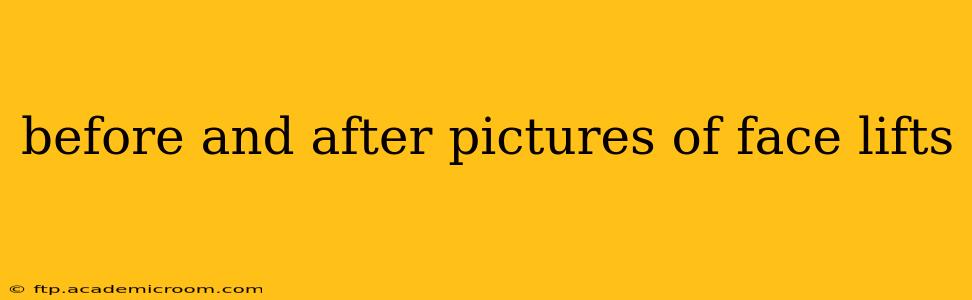 before and after pictures of face lifts