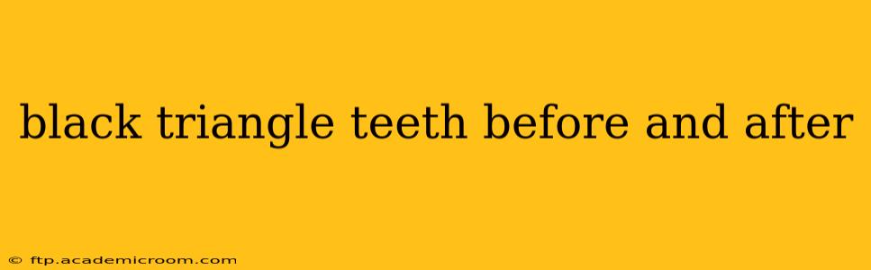black triangle teeth before and after