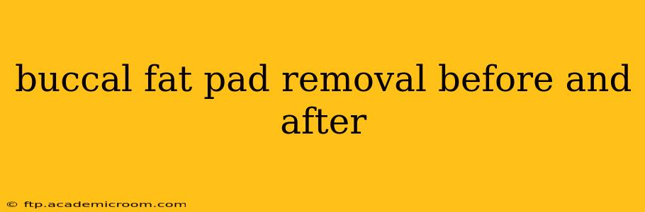 buccal fat pad removal before and after