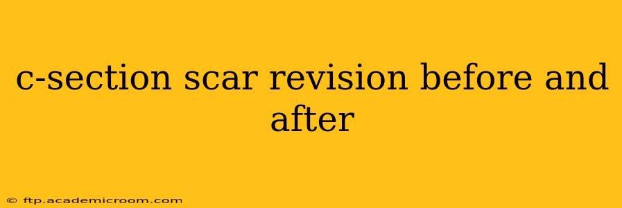 c-section scar revision before and after
