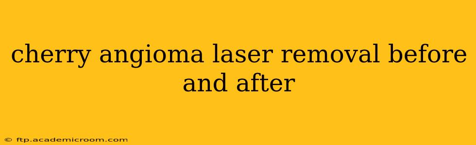 cherry angioma laser removal before and after