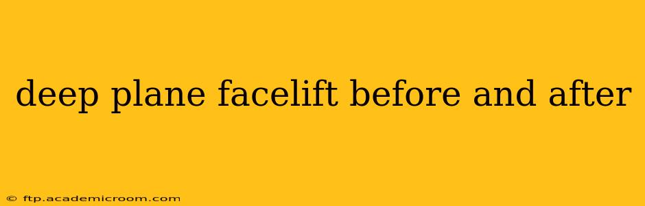 deep plane facelift before and after