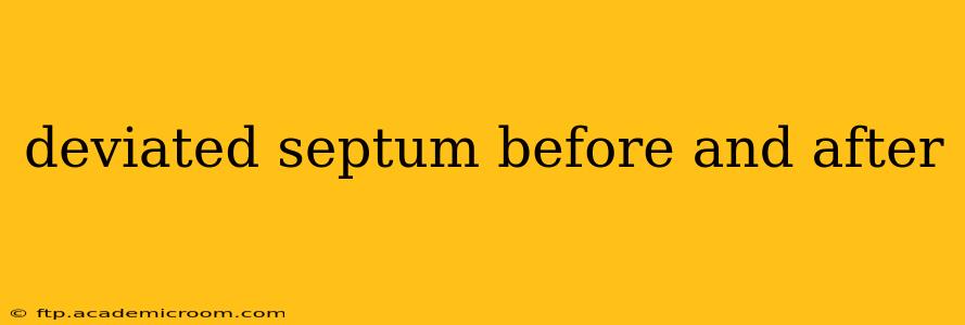 deviated septum before and after
