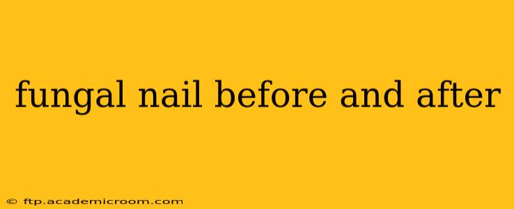 fungal nail before and after