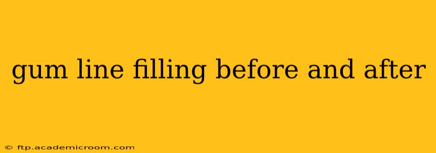 gum line filling before and after