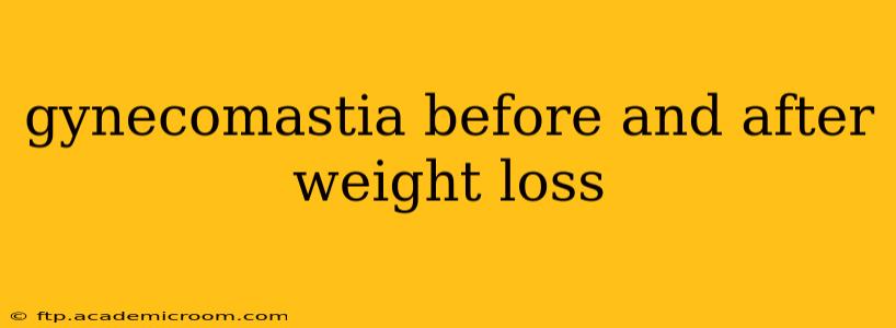 gynecomastia before and after weight loss