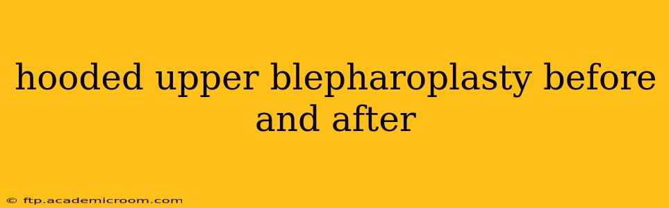 hooded upper blepharoplasty before and after