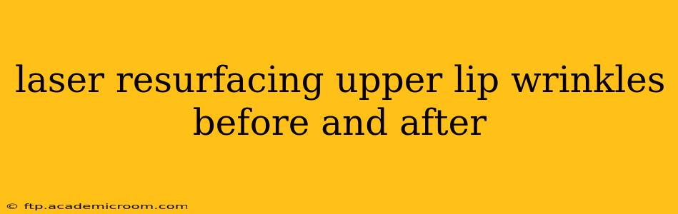 laser resurfacing upper lip wrinkles before and after