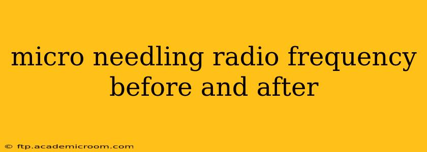 micro needling radio frequency before and after