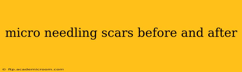 micro needling scars before and after