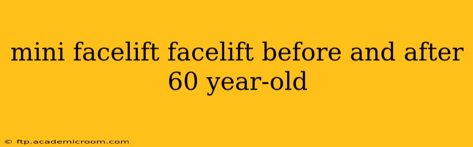 mini facelift facelift before and after 60 year-old