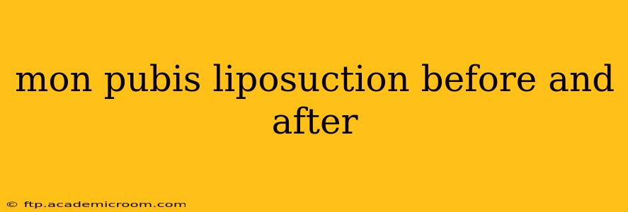 mon pubis liposuction before and after