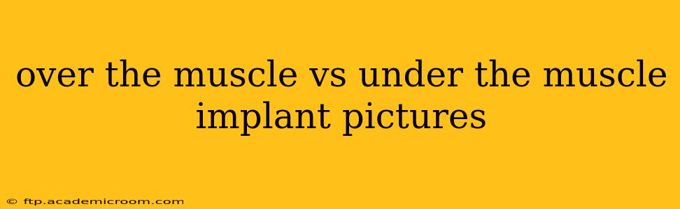 over the muscle vs under the muscle implant pictures