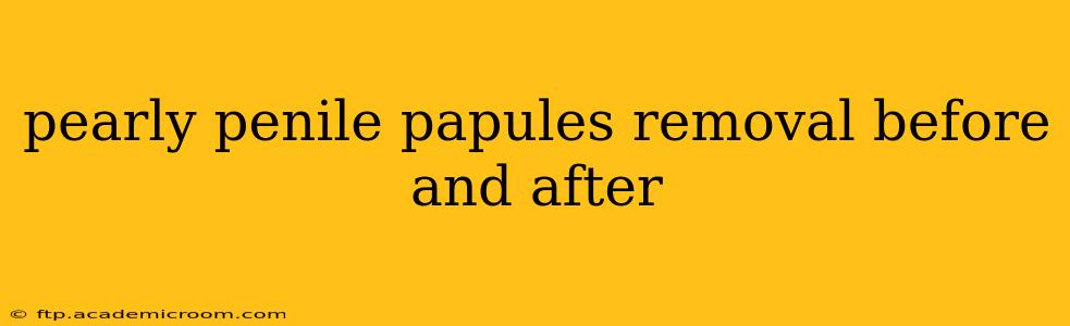 pearly penile papules removal before and after