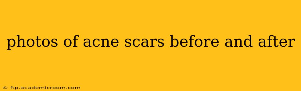 photos of acne scars before and after
