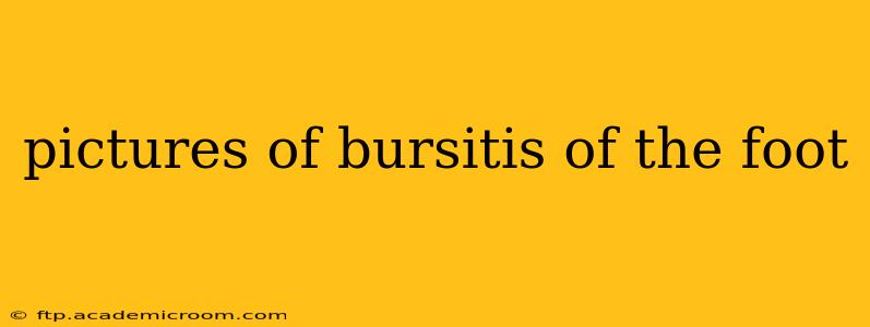 pictures of bursitis of the foot
