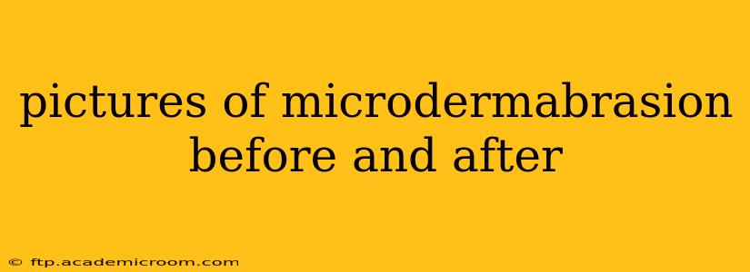 pictures of microdermabrasion before and after