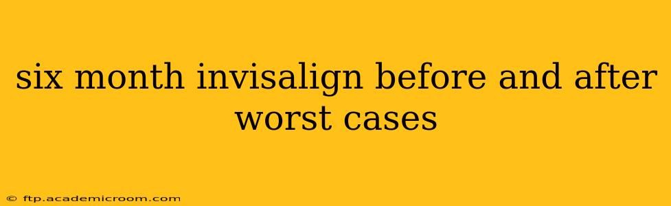 six month invisalign before and after worst cases