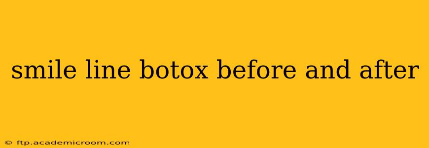 smile line botox before and after