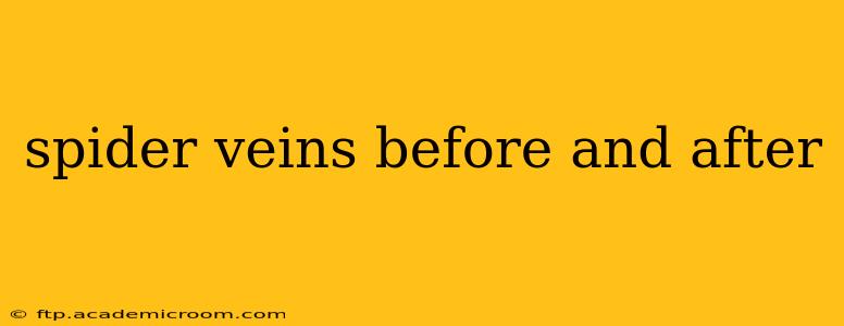 spider veins before and after