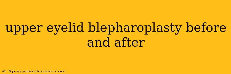 upper eyelid blepharoplasty before and after