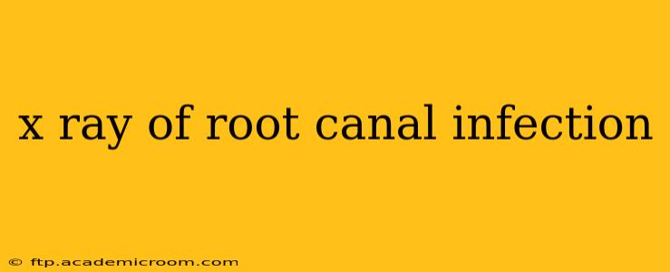 x ray of root canal infection